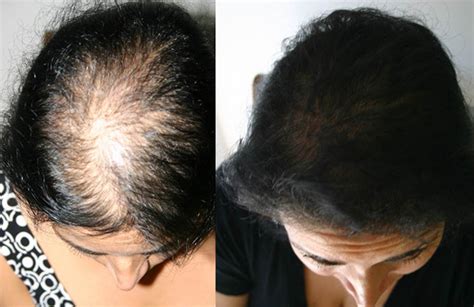 Causes of excessive loss of hair range from heredity to medical conditions to styling issues. Female Hair Loss Patient 1 | Limmer Hair Transplant Center