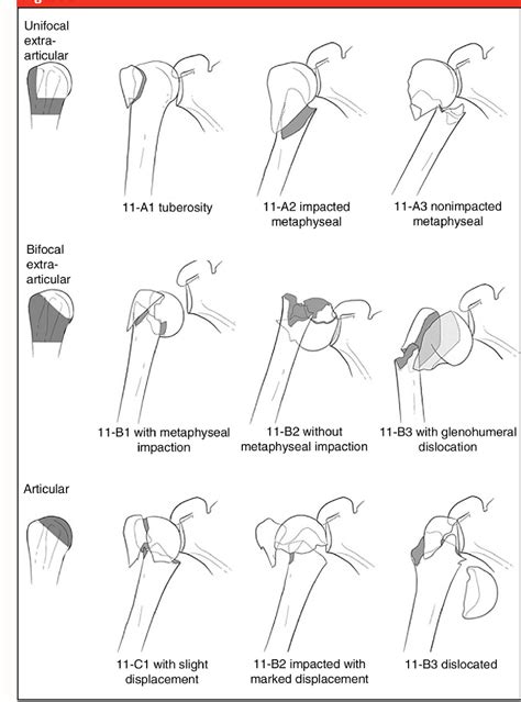 Figure From Management Of Acute Proximal Humeral Fractures Semantic Scholar