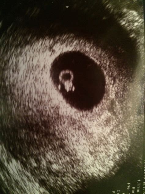 Miscarriage At 6 Weeks Pictures In Toilet
