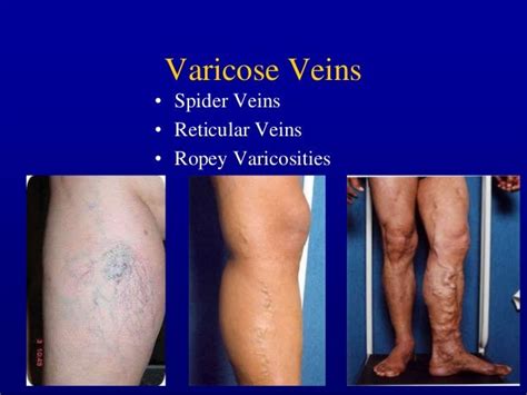 Management Of Incompetence In The Axial Veins