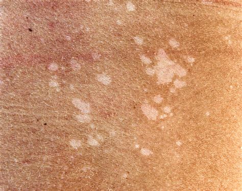 Skin Fungus Tinea Versicolor Stock Photos Pictures And Royalty Free