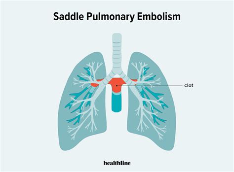 Pulmonary Artery Segmental Anatomy