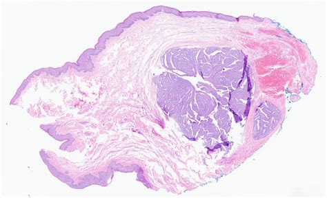 Pathology Outlines Hidradenoma Papilliferum