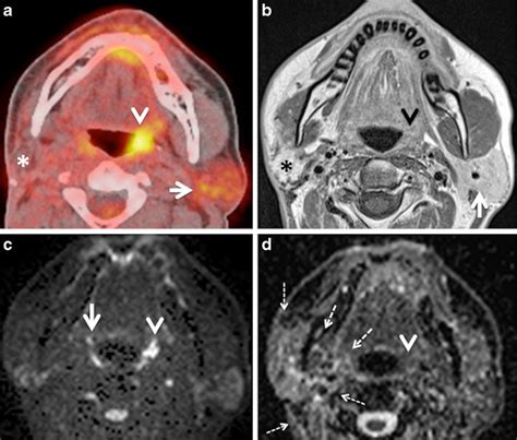 A Axial Pet Ct Image Demonstrates Asymmetrical Fdg Uptake Of The