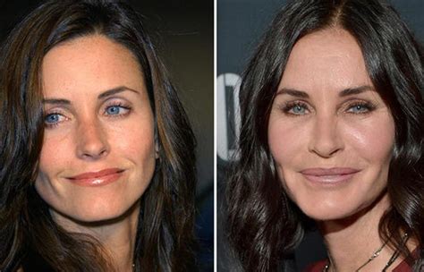 Celebrity Nose Jobs Before And After Plastic Surgery Celebrities Before And After