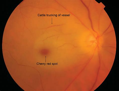 Retinal Artery Occlusion Causes Symptoms Diagnosis Treatment And Prognosis