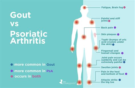 Gout Arthritis Guideline Gout Healer