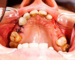 Excessive tooth decay, tooth infection, and crowding can all require a tooth extraction. Tooth extraction pain, healing and cost: Your guide to ...