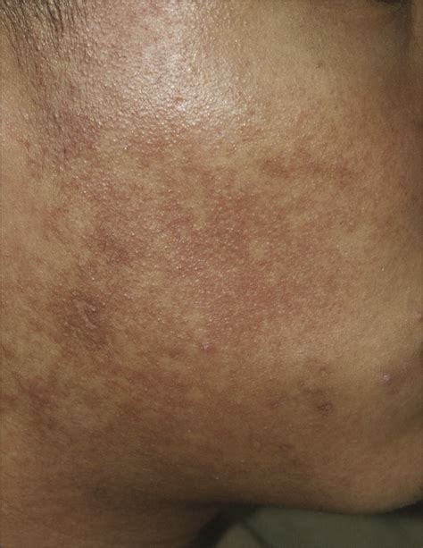 Asymptomatic Red And Brown Lesions On The Face And Neck Of A 15 Year