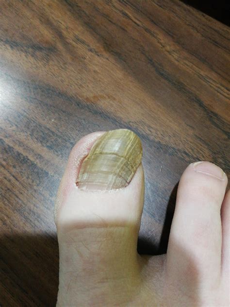 Regrowing Toenail Looking Like This Should I Get It Looked At R