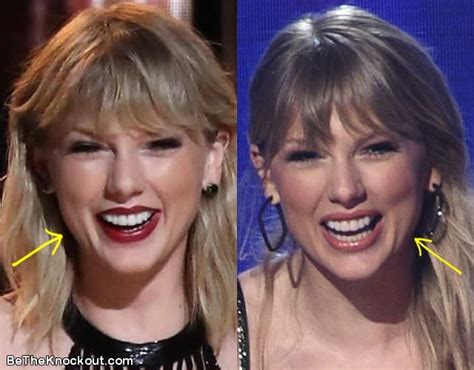 Taylor Swift Plastic Surgery Before And After Vrogue Co