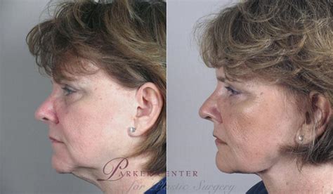 Neck Contouring Before And After Photo Gallery Paramus Nj Parker