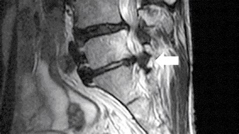 Man With Major Spinal Surgery Booked Actually Had A Toothpick In His