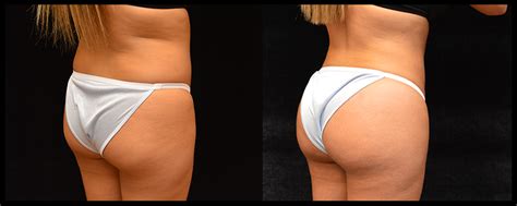 But for some, even the most disciplined workout regimen can't create the significant boost they want. Patient #616 Brazilian Butt Lift Before and After Photos ...