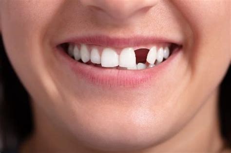 Restoring Missing Teeth Amy Mandalia Dds Cosmetic And General Dentistry