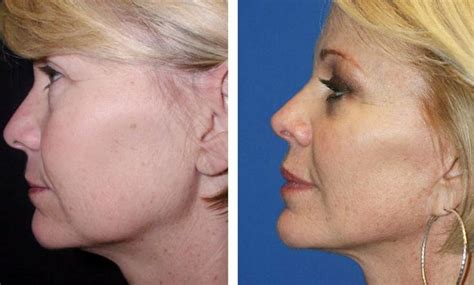 pin on lift drooping face skin and sagging jowls with face training workouts