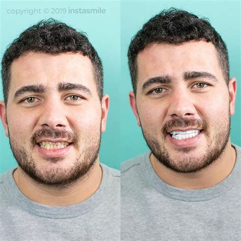 transform your smile and hide discoloured teeth without invasive surgery or a hefty price tag 💸👆