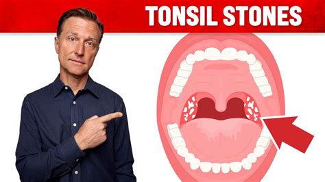 What Causes Tonsil Stones And How To Prevent Them All About Diabetes