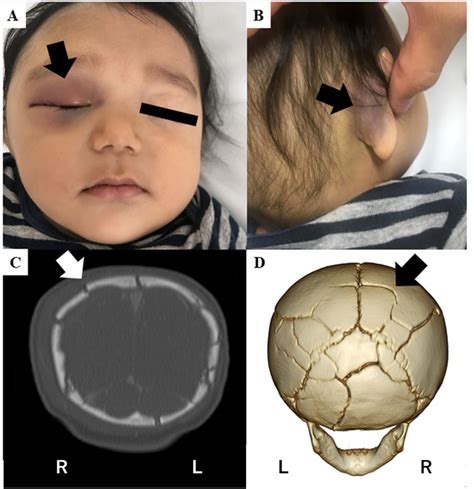 Raccoon Eye And Battles Sign In An Infant With Multiple Wormian Bones