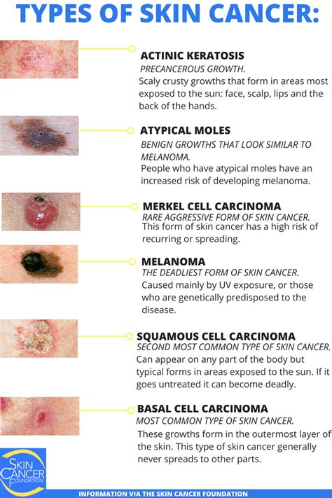 Skin Cancer Types Images Symptoms Rash Spots Bumps Skin Cancer My XXX
