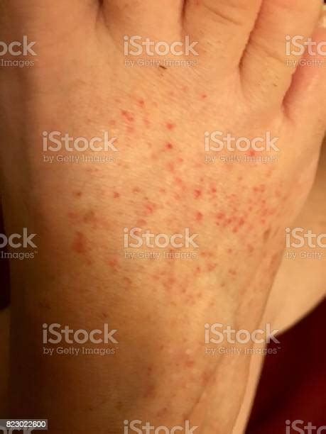 Tiny Red Spots Or Rash On Top Of Foot Stock Photo Download Image Now
