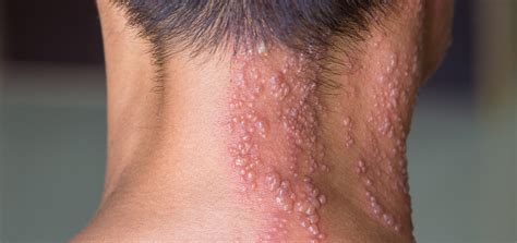 Shingles Rash Early Stages