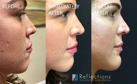 Chin Filler And Botox For Chin Dimpling In Young Woman Before And After