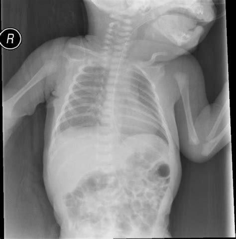 Spontaneous Pneumothorax In A Newborn Case Report Original Image
