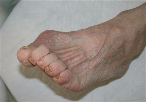 Causes Of Diabetic Foot Lesions The Lancet