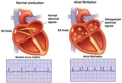 Know About Cardiac Arrhythmia Irregular Heartbeat