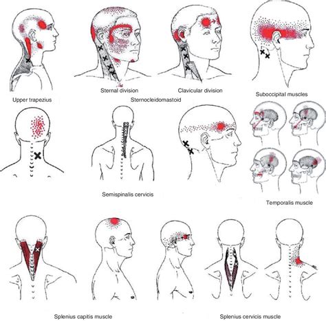 Figure 1 From Myofascial Trigger Points And Sensitization An Updated