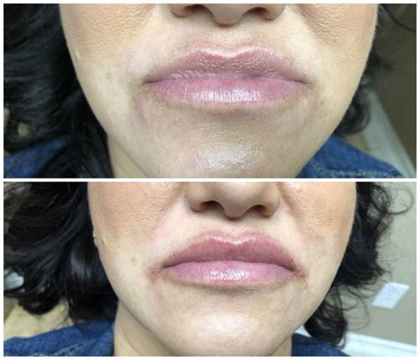 Before N After One Syringe Of Juvederm Ultra Plus Xc To Plump Lips