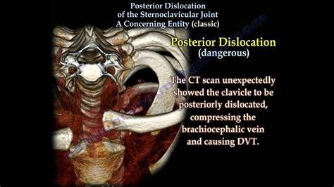 Posterior Dislocation Sternoclavicular Classic Everything You Need To