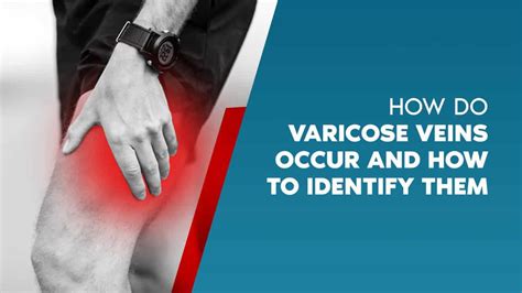 Varicose Veins Symptoms Vascular Interventions Hyderabad