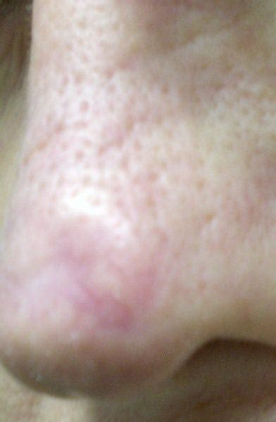 Little White Bumps Newborn Face Breakout How To Get Rid Of Bump On My