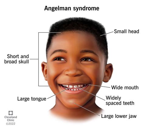 Apa Itu Angelman Syndrome Media Perawat Id