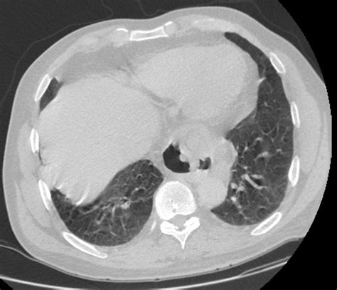 Ct Image Demonstrating The Appearance Of A Recurrent Hiatal Hernia