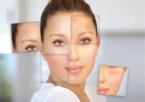 Can You Prevent Acne Skin Perfection