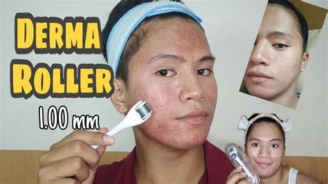 How To Use Derma Roller For Acne Scars And Marks Youtube