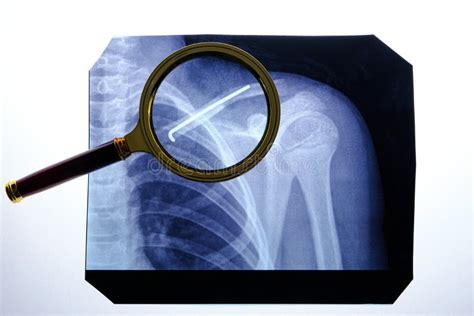 X Ray Broken Collarbone And Spoke Inserted Into It Stock Photo Image
