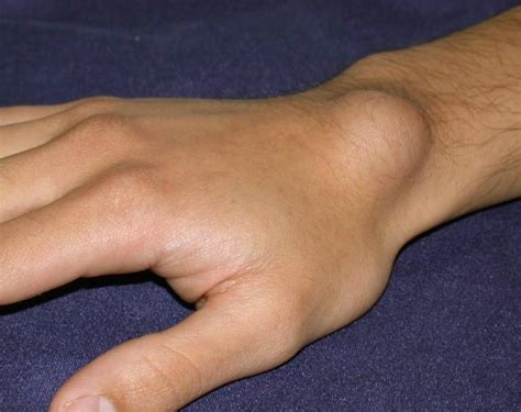 Ganglion Cyst Of The Wrist Robert J Snyder Md Osc