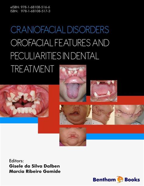 Craniofacial Disorders Orofacial Features And Peculiarities In Dental