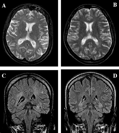 Brain Mri Of Two Homozygous Dm2 Patients T2 Weighted A And B And
