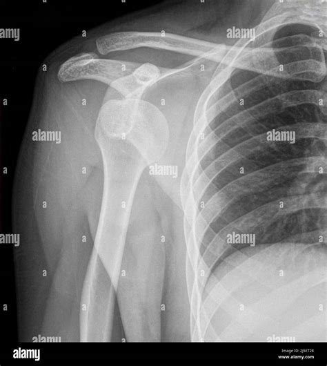 Dislocated Right Shoulder X Ray Stock Photo Alamy