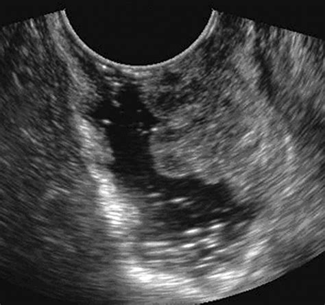 perspective on the role of transrectal and transvaginal sonography of tumors of the rectum and