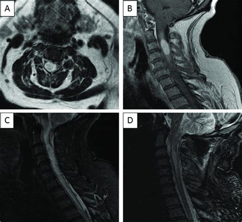 Mr Images Of The Patients Cervical Spine At Presentation And After A