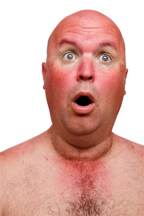 How Does Sunburn Damage The Skin How It Works Magazine