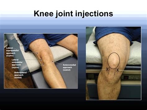 Corticosteroid Injections In Orthopaedics