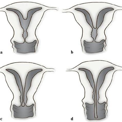 Sepatate Uterus Partial A And Complete B Uterine Septum