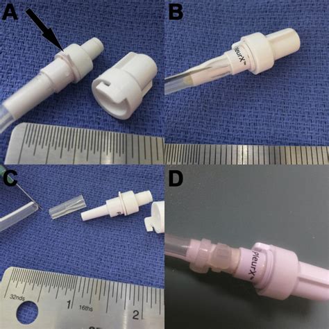 Repair Of Tunneled Pleural Catheter Chest